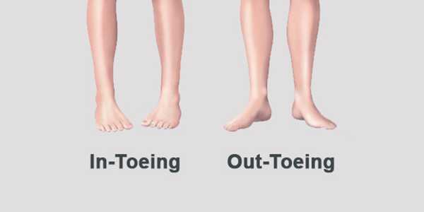 Is Your Child Walking Pigeon-Toed? Here’s How To Correct It